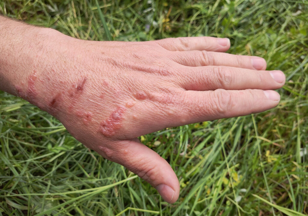 A hand with blisters from Giant Hogweed burns